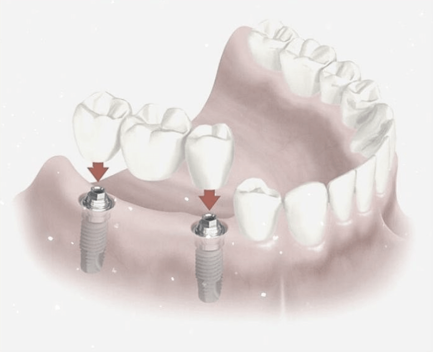 Implantes Dentales en Esplugas